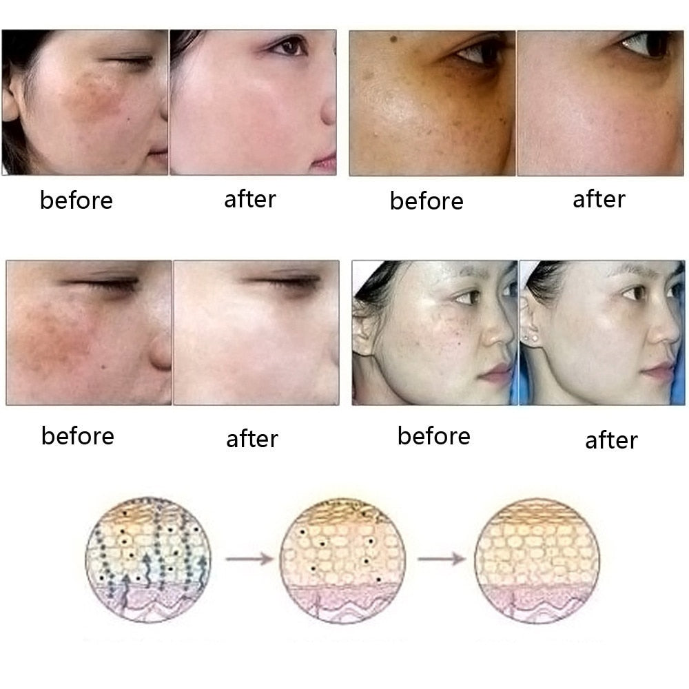 Natural Pure Removal Acne Stretch Marks Scar Removal Essence oil